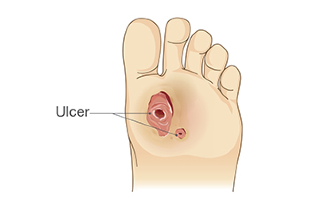 Circulation Problems and Foot Ulcers