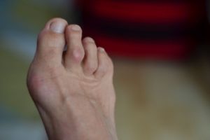 Types of Hammertoe Treatments