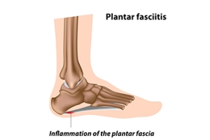 Plantar Fasciitis in Children