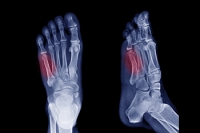 Jones Fracture Symptoms