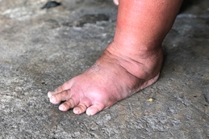 Swollen Feet