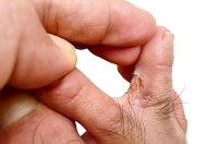 What to Do if You Have Athlete’s Foot