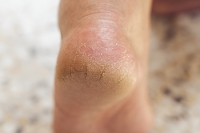 Painful Cracked Heels