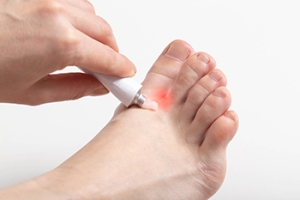 Treatment and Prevention of Athlete’s Foot