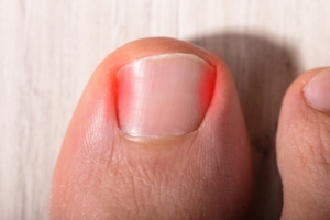 Why Is My Toenail Ingrown?